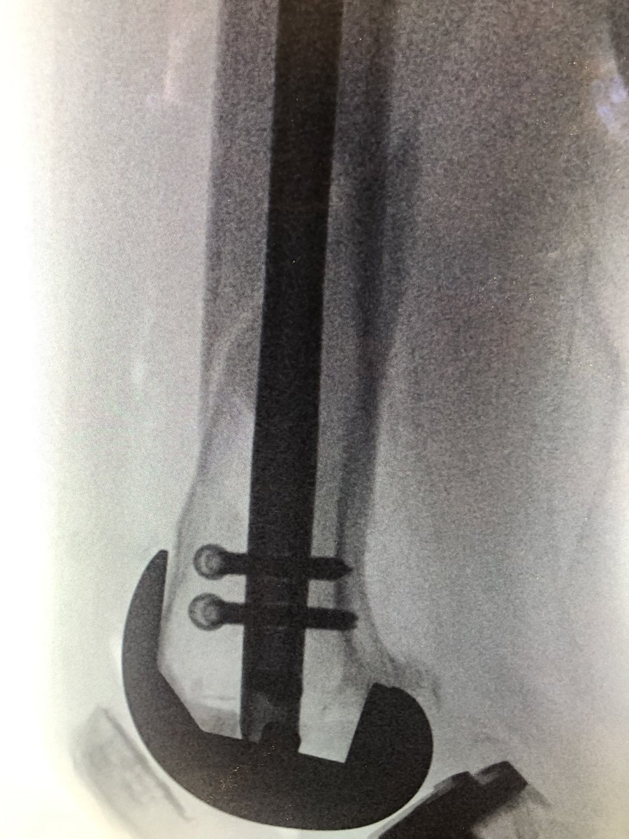 [5/5] Finals. Looks great on AP, but on lateral we still ended up with a little malreduction because starting point limited. But bone was good and 3 screws in distally, so I was not concerned. If you want a paper about which knees have a posterior start:  https://pubmed.ncbi.nlm.nih.gov/24929282/ 