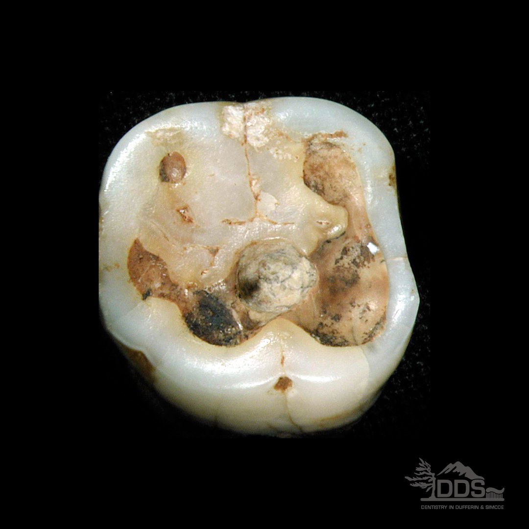 #DYK that cavities in teeth have been filled since the earliest of times with a variety of different materials, including gum, stone chips and even turpentine resin? 🦷

☎️ (705) 445-0551