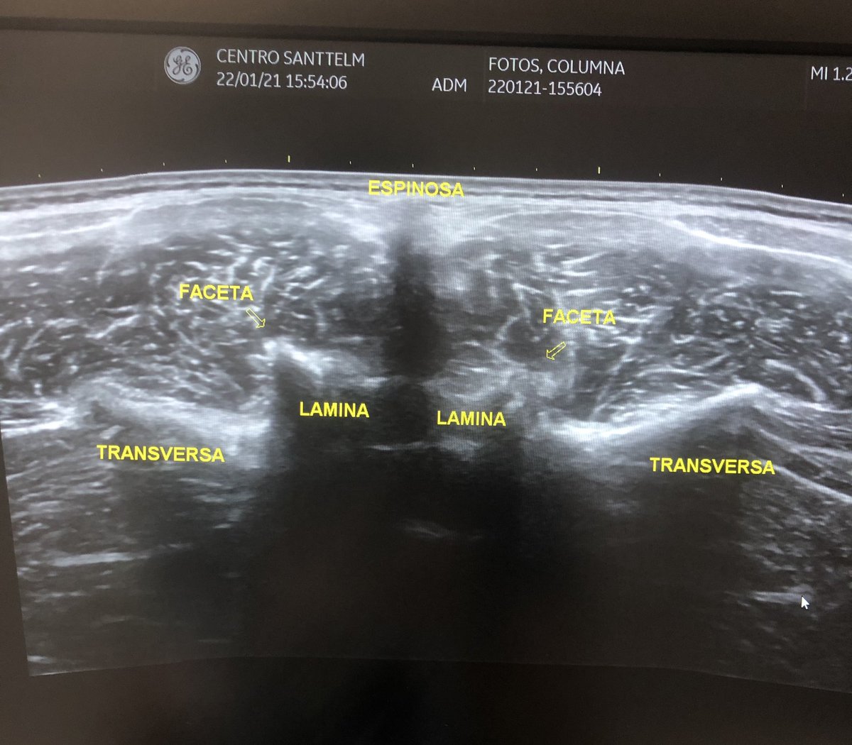 Ecografía vertebral lumbar 

#centrosanttelm #ecografia #sonography #neuroeje #fisioterapia #columnavertebral #lumbares #lumbalgia #facetas