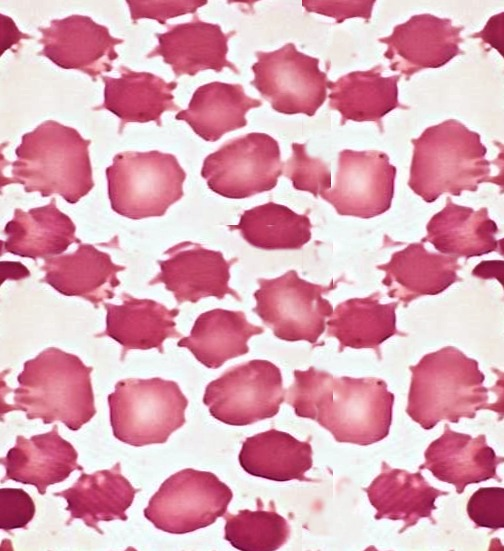 RosenelliEM's tweet photo. See these little spicules on your smear? What are they?

Acanthocytes of course. They are caused by alterations in membrane lipids/proteins &amp; occur in pts w/ severe liver dysfunction, neuroacanthocytosis, abetalipoproteinemia, malnutrition, hypothyroidism, post-splenectomy, etc https://t.co/pHoY2iNkJ3