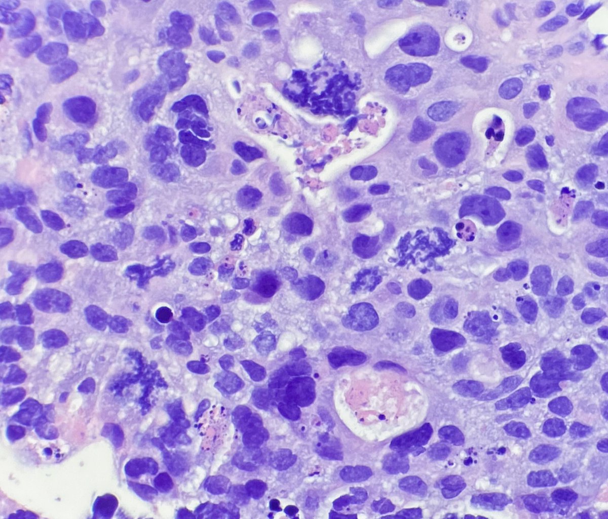 Amazing #mitoses. #SquamousCellCarcinoma