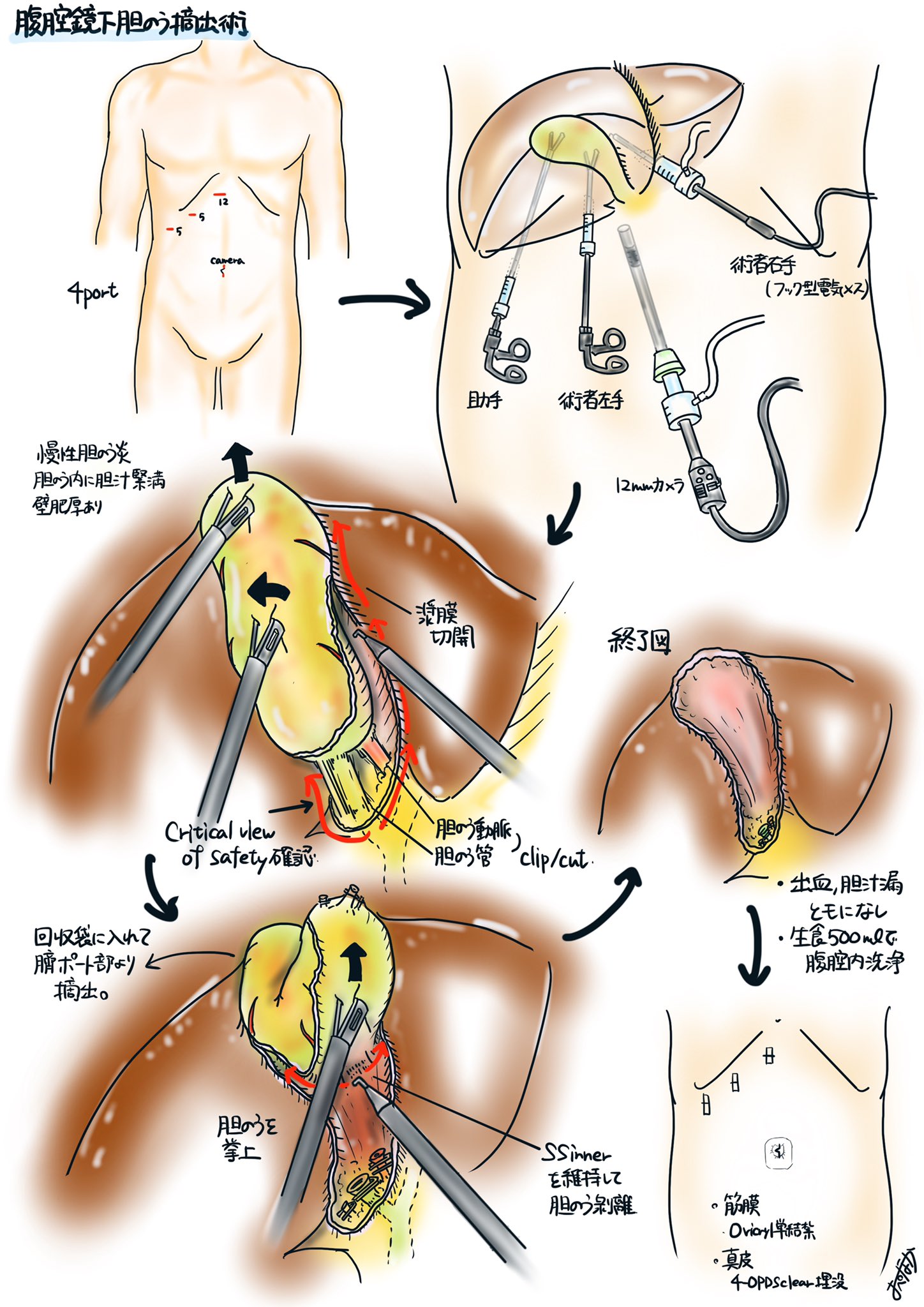 腹壁吊り上げ法による腹腔鏡下胆嚢摘出術 スム-ズな手術を行うためのノウハウ/南山堂/橋本大定（ペーパーバック） 腹壁吊り上げ法による腹腔鏡下胆嚢摘出術 スム-ズな手術を行う
