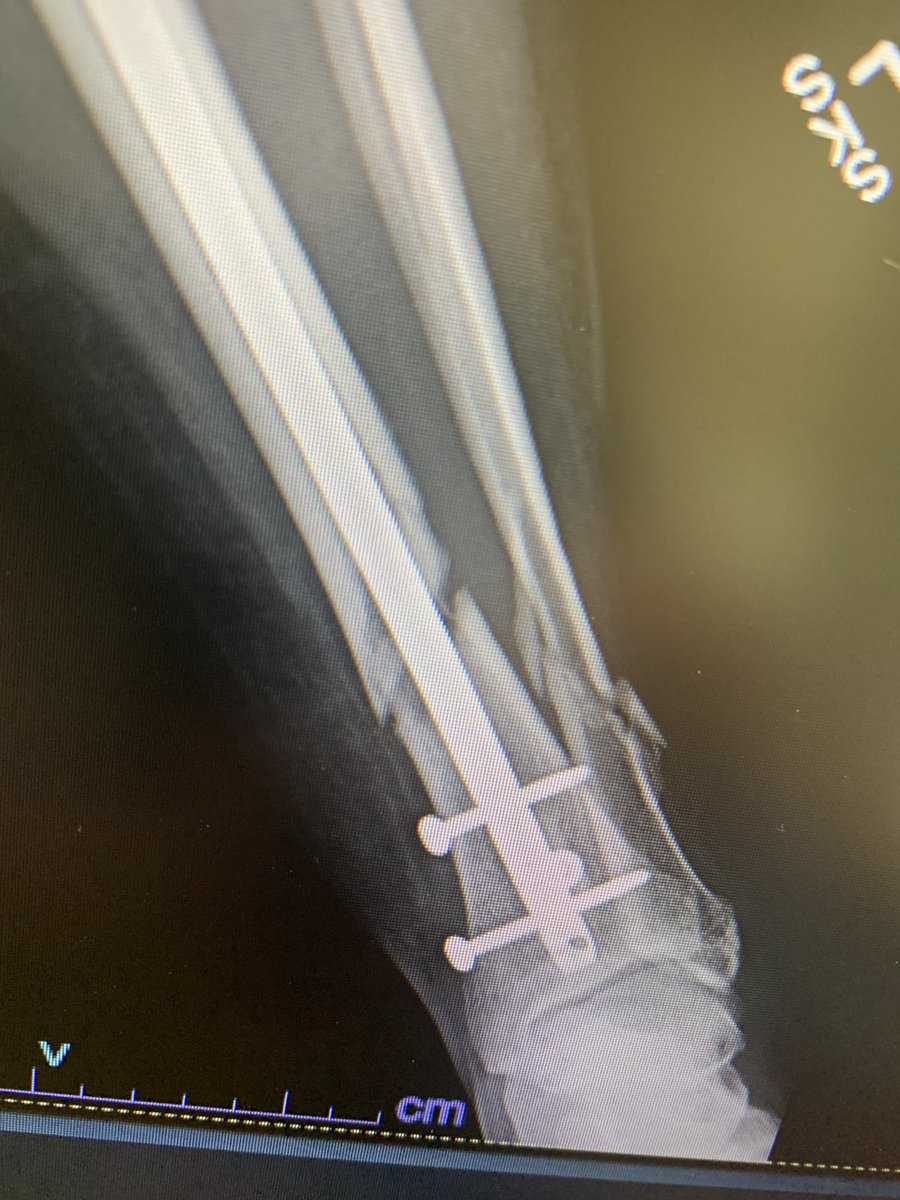 Mid 50s F. 3 months post op. Closed fx. No signs of healing. Non smoker, no DM, +celiac dz, on high dose vit D and Ca++. Has BAD CRPS. 3 screws due to poor bone quality. Working on bone stimulator. Next steps?  #orthotwitter  @TraumaRuberINT  @rkh_md  @OfficialAKLee  @InvictaOrtho