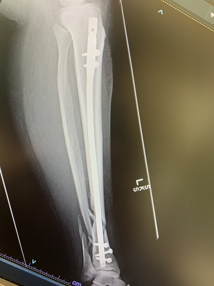 Mid 50s F. 3 months post op. Closed fx. No signs of healing. Non smoker, no DM, +celiac dz, on high dose vit D and Ca++. Has BAD CRPS. 3 screws due to poor bone quality. Working on bone stimulator. Next steps?  #orthotwitter  @TraumaRuberINT  @rkh_md  @OfficialAKLee  @InvictaOrtho