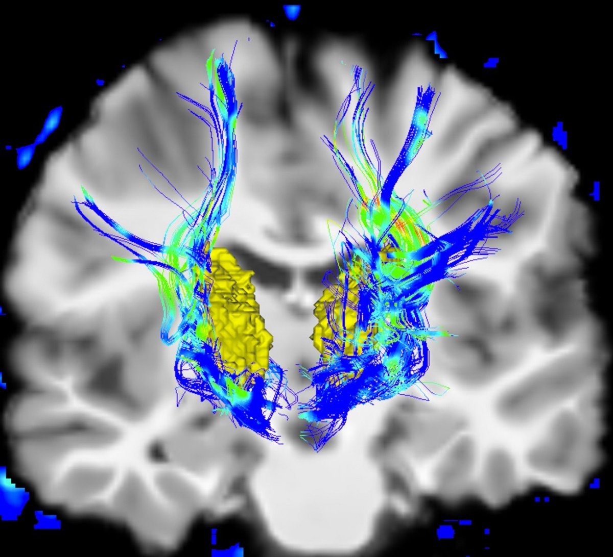 Excited to see our new work out in <a href="/NeuroCellPress/">Neuron</a> on how subthalamic nucleus helps us stop actions!  Check out this great summary by <a href="/CedarsSinai/">Cedars-Sinai</a> (cedars-sinai.org/newsroom/study…). Paper linked below: