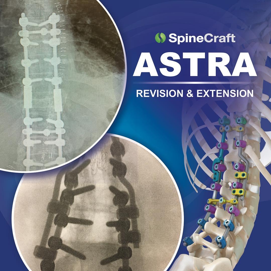 ASTRA Revision &amp; Extension: WHEN YOU NEED TO GET TO THE NEXT LEVEL. Request more information: spinecraft.com/contact-us.html

ASTRA Deformity Spine System