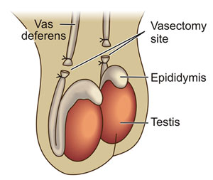 A vasectomy is a surgical procedure where the male vas deferens (a tube that carries sperm from the testes to the ejaculatory ducts) is tied off and cut. It's a permanent method of contraception for men who have completed their families. Similar to bilateral tubal ligation (BTL)
