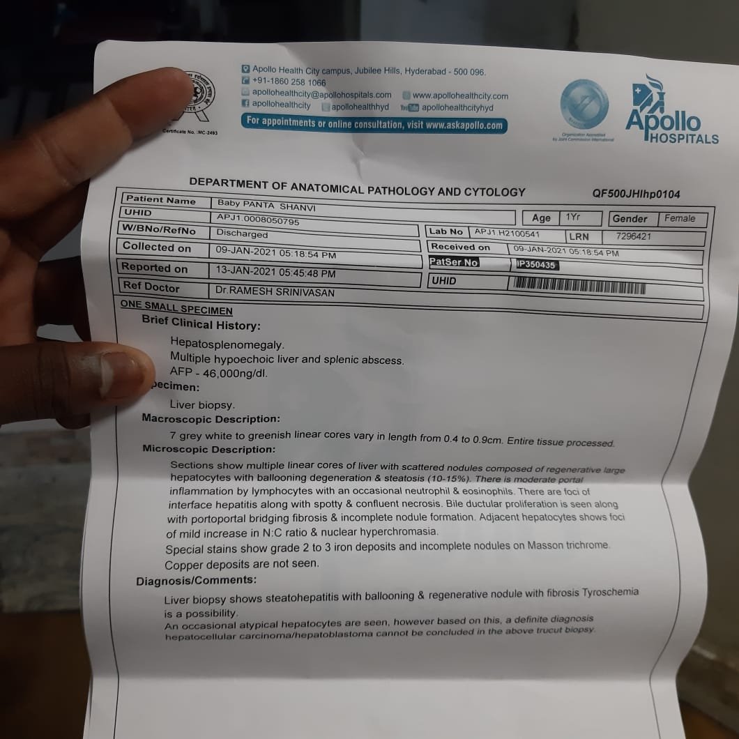 BoggarapuSunan1's tweet photo. @BeingSalmanKhan 
Hi sir my name is sunanda . 
My 17 months old baby shanvi is diagnosed with tyrosanemia type 1
She needs to undergo liver transplant. Plz help us sir https://t.co/NpTgkkj6Fv