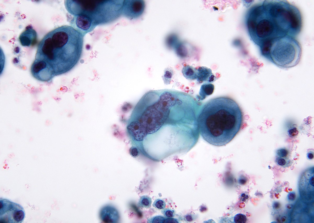 Another example of cells looking extremely hideous - "When Looks Could Kill" - You can teach the interns what "Cellular Pleomorphism" is (Metastatic Ovarian CA in abdominal fluid).