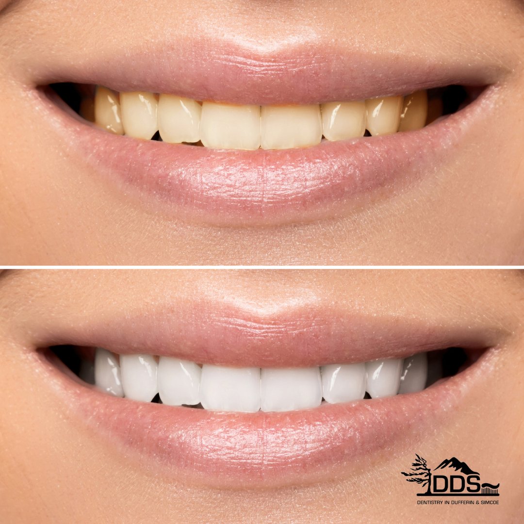 Tooth whitening or bleaching is a simple, non-invasive dental treatment used to change the colour of natural tooth enamel and is an ideal way to enhance the beauty of your smile.

CALL US TODAY to get started! 👄

☎️ (705) 445-0551