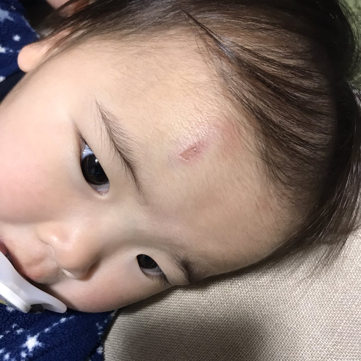 さだ 保育園でコケて タンスの角 に頭ぶつけて この状態 寝屋川 大阪 Family 6人家族 4人兄弟 子だくさん 大家族 野球 Baseball Sunred サンレッド Voxy Yummy 末っ子次女 1歳児 1歳 青あざ たんこぶ 頭に傷 おでこに傷 一応