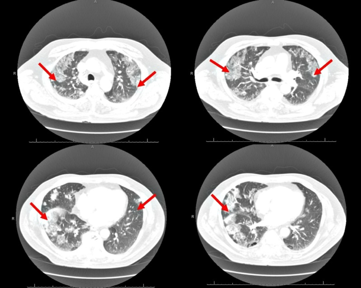 (6/10) DAP-induced eosinophilic PNA (AEP) should be suspected with DAP exposure + >25% eosinophils in bronch + fever + ‍ dyspnea + new diffuse bilateral infiltrates on CT/CXR.  https://www.ncbi.nlm.nih.gov/pmc/articles/PMC6207288/figure/FIG2/