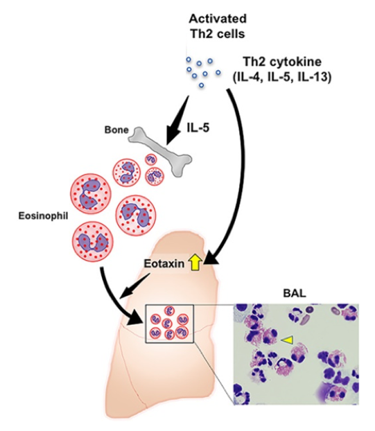 (5/10) #2: DAP interaction with surfactant  inflammation  T-cell activation  IL-5 release  eosinophil production  eotaxin attraction of eosinophils to the . (Picture:  https://onlinelibrary.wiley.com/doi/full/10.1002/iid3.238)