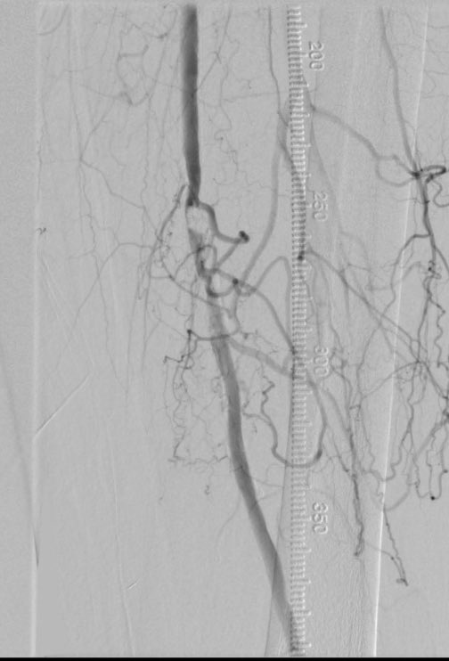 matheenkhuddus's tweet image. Great case last week to close out enrollment in FAST II evaluating the Freedom Flow orbital atherectomy device (currently limited to investigational use, not in commercial distribution). Excellent result with OA and PTA alone. Look forward to the trial results! #SCAIPAD @TCAVIRF