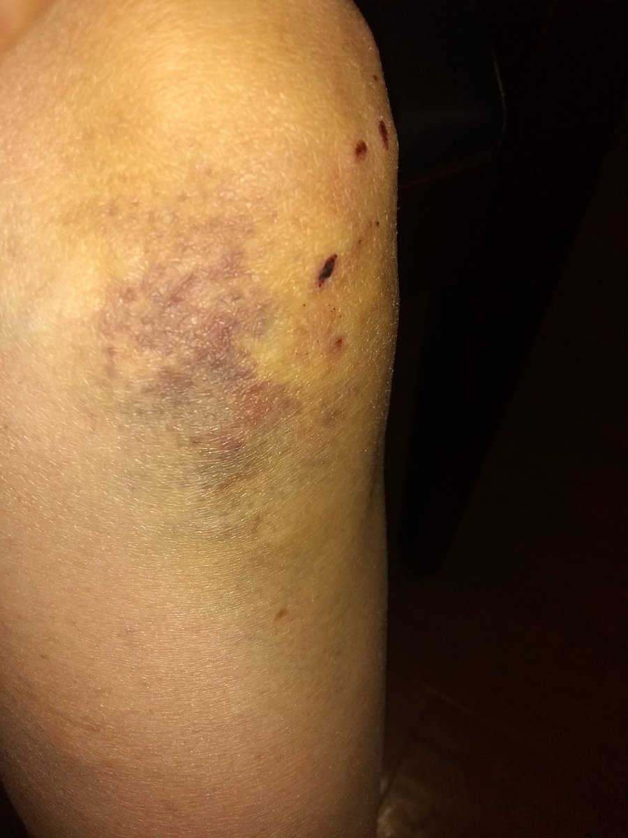 EmberReine's tweet photo. Down Domme.  Split eyebrow before/after butterflies and bruised knee.  I NEED pampering.  $end to make me feel better. @RT4BOSS @SubmitLoser @rt4_sex @FootObsession_ https://t.co/GAo4gFvEBQ