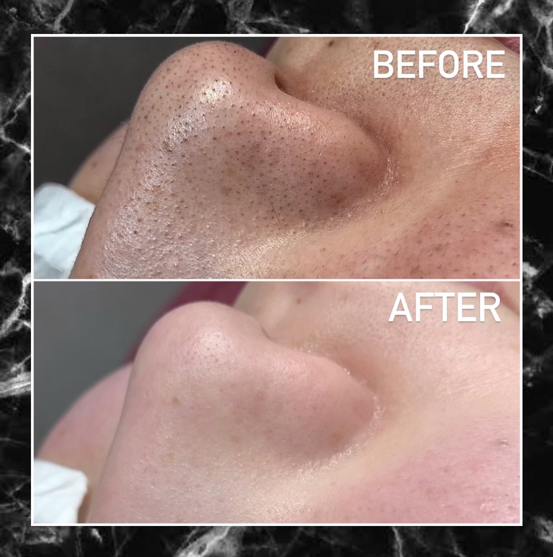 ナージュクリニカルサロン 毛穴クリーンケア 毛穴 毛穴の黒ずみ 毛穴の詰まり 毛穴洗浄 名古屋エステ ナージュ ナージュクリニカルサロン 美肌 美容 肌改善