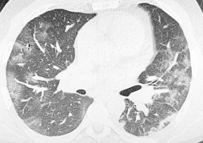 I was a very fit and healthy 45yo male with no comorbidity or any risk factors. These are my lungs 14 days ago. I survived thanks to the amazing medical care I received and am now recovering. COVID is no joke. Please people keep doing the right thing and staying safe.