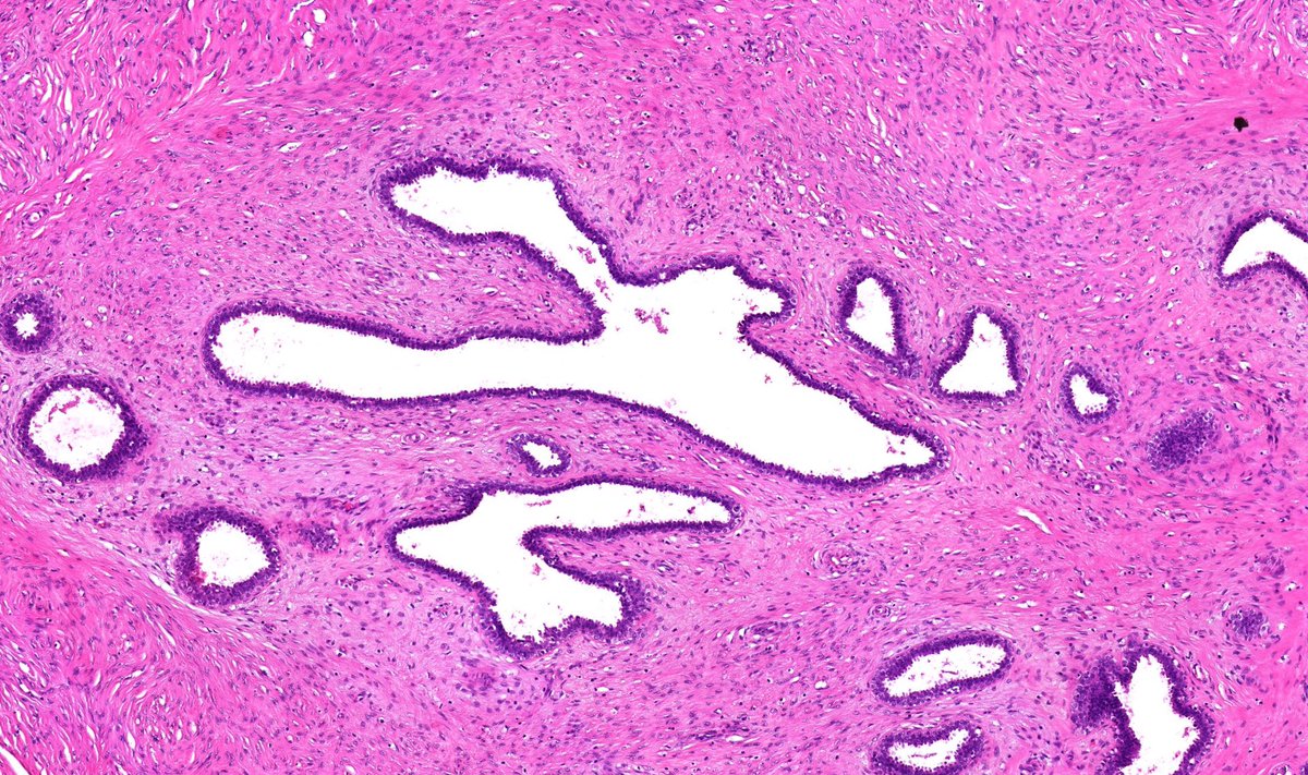 Immunohistochemistry:Epithelium and stroma: ER /PR