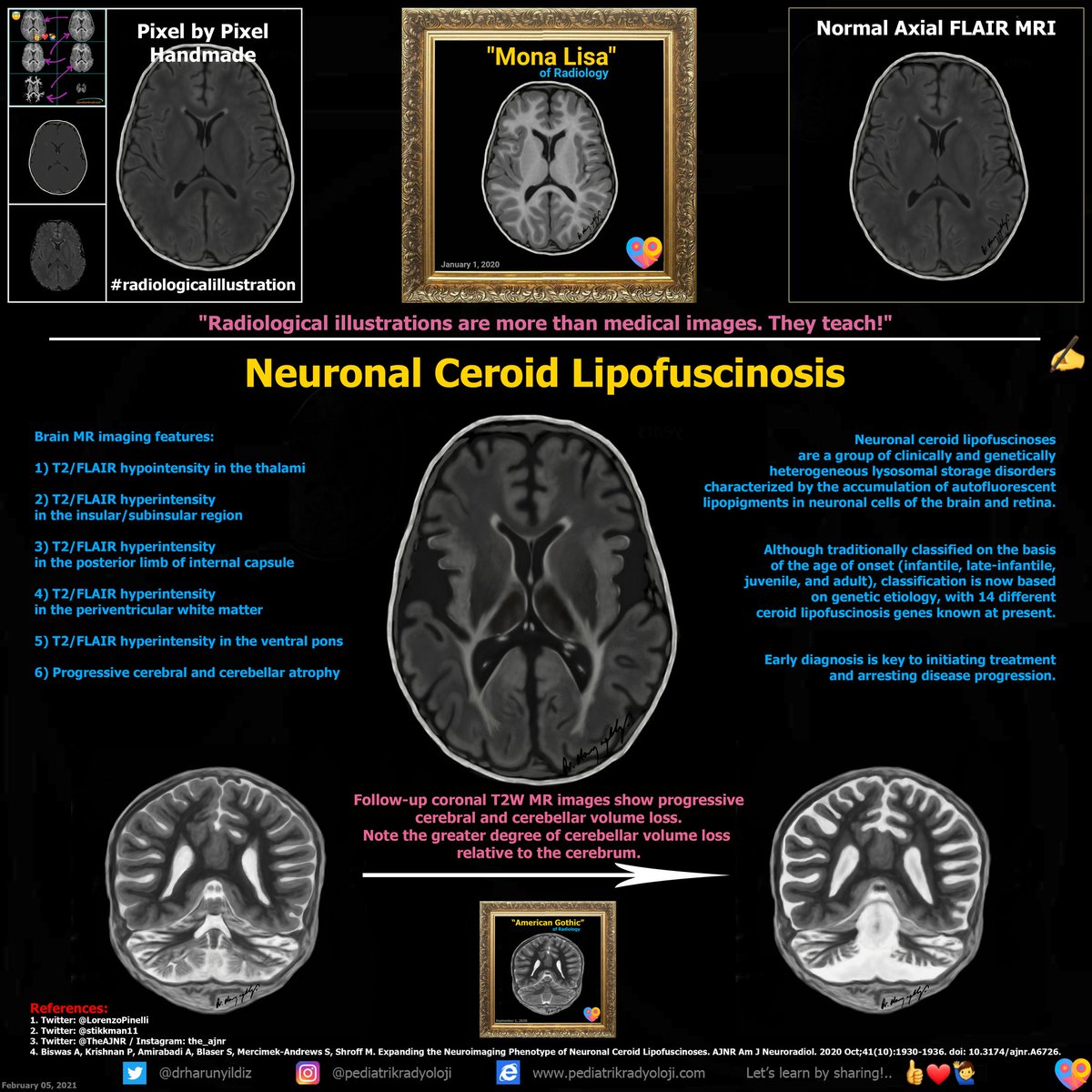 Neuronal Ceroid Lipofuscinosis 

References:
1. @LorenzoPinelli
2. @stikkman11
3. @TheAJNR

Watch out!
These images aren't real MR images! 😇 

'Pixel by Pixel Handmade' ✍ 

#medtwitter #radiologicalillustration #pedineurorad #pediatrikradyoloji #meded #neurad #pedsrad