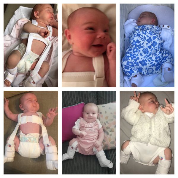 Developmental dysplasia of the hip (DDH) is a health problem of the hip joint. Many kids are suffering from this.
torc2 Ltd wants to help children with Hip Dysplasia. 

Learn more about what we are trying to achieve: torc2.com

#makingpositivechange #lowerlimbcondit