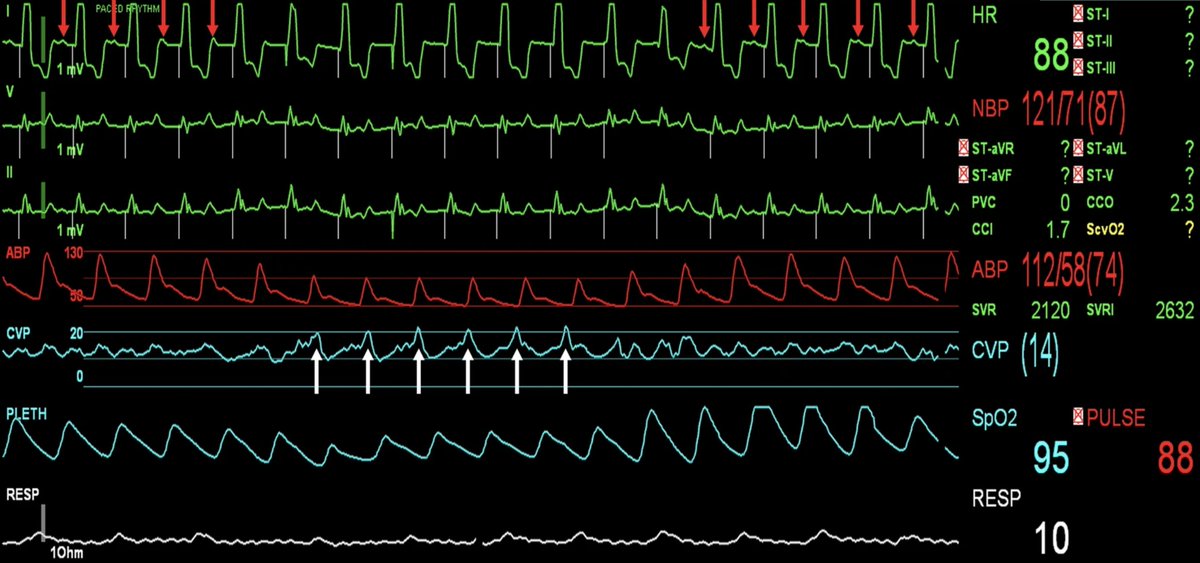 Post #CPB (AVR for severe Ao stenosis)
➡️epicardial pacing wires on site (RV)
➡️CI 1.7 L/min/m2
➡️SVV 62%
➡️PPV
➡️CVP 14 mmHg, some Cannon A waves (white arrows)
➡️P waves (red arrows)
What's going on? try to guess! (before reading...)
Open access <a href="/yourICM/">Intensive Care Medicine</a> rdcu.be/ceOHo