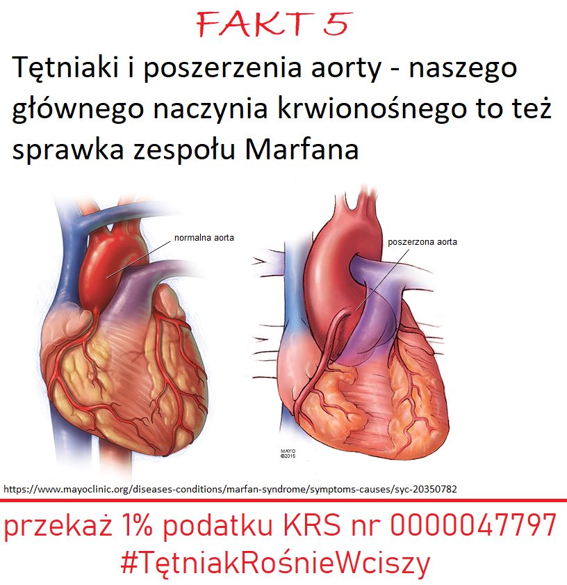 #TętniakRośnieWCiszy #aorticdissection #AorticED #MarfanAwareness #LutyMiesiącemChoróbRzadkich #raredisease