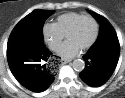 Jannette Collins, MD, MEd, FACR (@jannimd) on Twitter photo Do you recognize what this is?
#ChestRadEd <a href="/ACER_AUR/">ACER AUR</a> <a href="/theAPDR/">The APDR</a> <a href="/StefanTigges/">Stefan Tigges</a> @TanMohammedMD <a href="/nkagetsu/">Nolan Kagetsu (花 月), MD (he/him)</a> <a href="/CsFuss/">Dr. Cristina Fuss</a> <a href="/LaurenGroner/">Lauren Kriger Groner</a> <a href="/CameronAdlerMD/">Cameron Adler</a> <a href="/AlexanderRandMD/">Alexander Rand</a> <a href="/Jaswal_Shama/">Shama Jaswal</a> <a href="/jonherochung/">Jonathan Chung, MD</a>
Answer: Esophageal diverticulum. CT shows a sac of air and debris abutting the esophagus. Do you recognize what this is?
#ChestRadEd <a href="/ACER_AUR/">ACER AUR</a> <a href="/theAPDR/">The APDR</a> <a href="/StefanTigges/">Stefan Tigges</a> @TanMohammedMD <a href="/nkagetsu/">Nolan Kagetsu (花 月), MD (he/him)</a> <a href="/CsFuss/">Dr. Cristina Fuss</a> <a href="/LaurenGroner/">Lauren Kriger Groner</a> <a href="/CameronAdlerMD/">Cameron Adler</a> <a href="/AlexanderRandMD/">Alexander Rand</a> <a href="/Jaswal_Shama/">Shama Jaswal</a> <a href="/jonherochung/">Jonathan Chung, MD</a>
Answer: Esophageal diverticulum. CT shows a sac of air and debris abutting the esophagus.