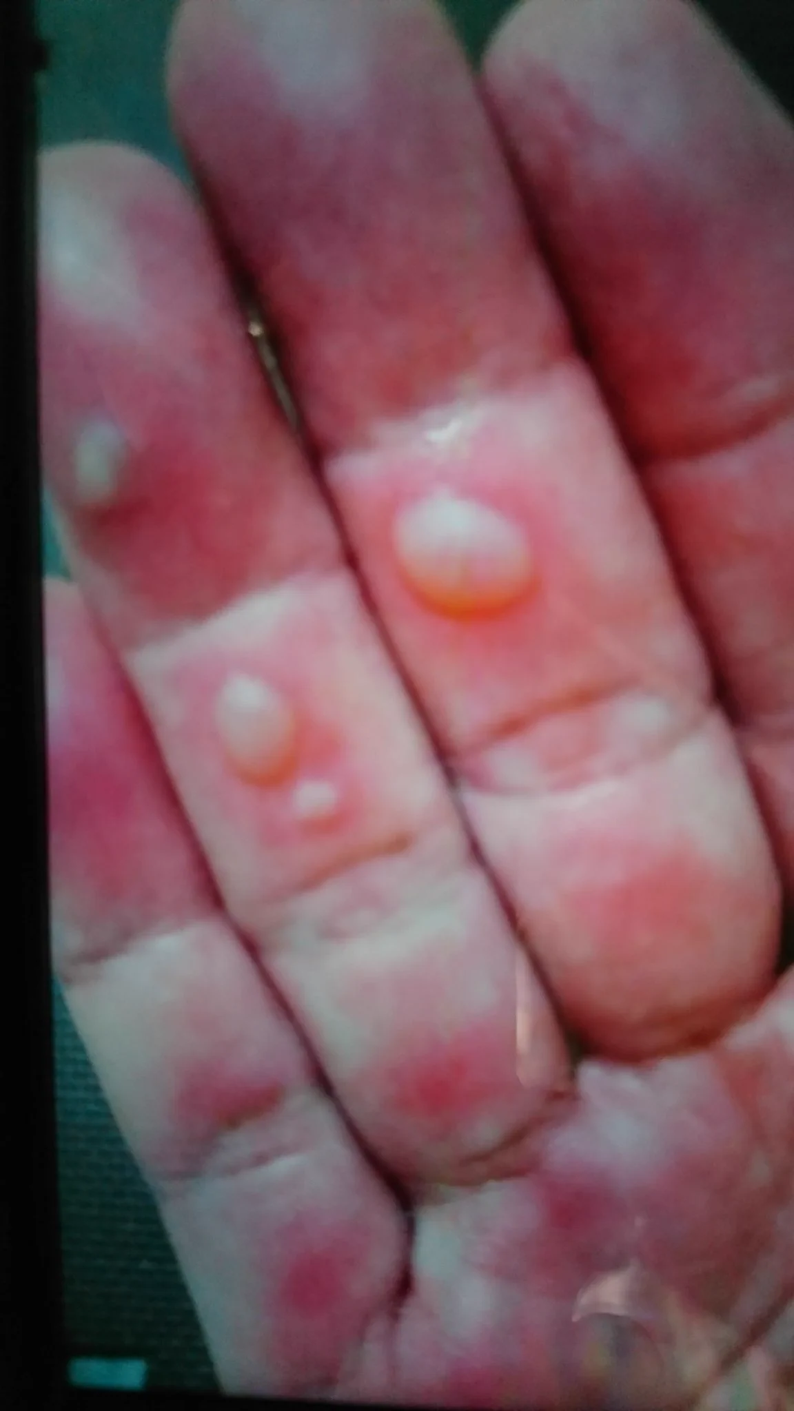 @9y2NM7zuz24sVfn 54才飴作りで、やけどした手、153度、の熱の飴は、軍手2枚重ねでも熱かったです。女性の方、気を付けてね🍀🍀🍀 