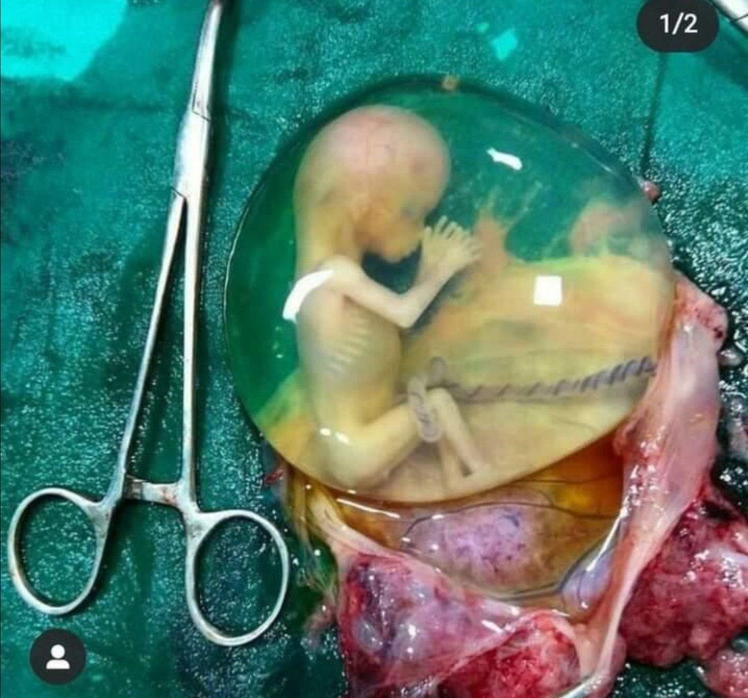 EshalNayyab's tweet image. Human fetal embryo.  #practicaltime #Zoologist