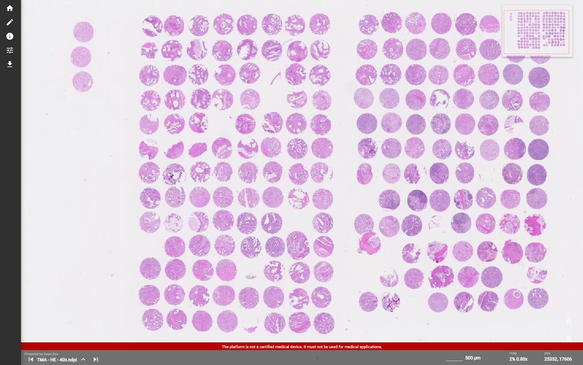 Our #AI Platform supports your tissue #microarray assays by a unique automated workflow. Discover how you can achieve this automatically within a few seconds and optimize your large throughput analysis > bit.ly/3jpq7yD