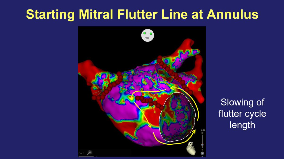 narrowQRS's tweet photo. Does the cycle length of atrial flutter change before the ablation line is completed? It depends on which direction you decide to make the line ๐ค
Learn more flutter tips & tricks in this a.flutter video series on the J&J Learning site!โฌ๏ธ
https://t.co/7CNgfNqvtz https://t.co/qpc7DYdOZD
