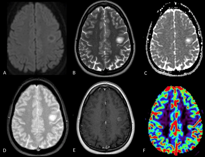 RadiolMed's tweet photo. Editor's Pick: NEURORADIOLOGY
Differential imaging of atypical demyelinating lesions of the central nervous system
https://t.co/WTQGaXe14Q
@ClinMedJournals #neuroscience @bastianellos @unipv https://t.co/T5SlHHgDLT