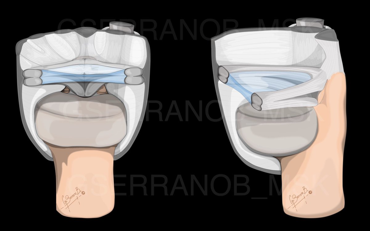 Illustration of one of my favorite topics..TFCC. #mskrad #mskradiology #radiology #tfcc #medart