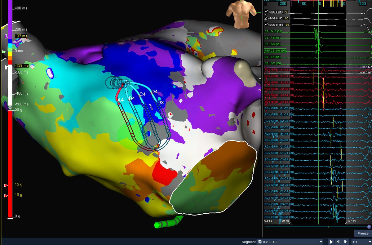 maddyferraro1's tweet image. Fun redo atypical flutter around an anterior scar with @FrischMd &amp;amp; @ryancolemaps @AbbottCardio #HDGrid #mapmoreburnless
