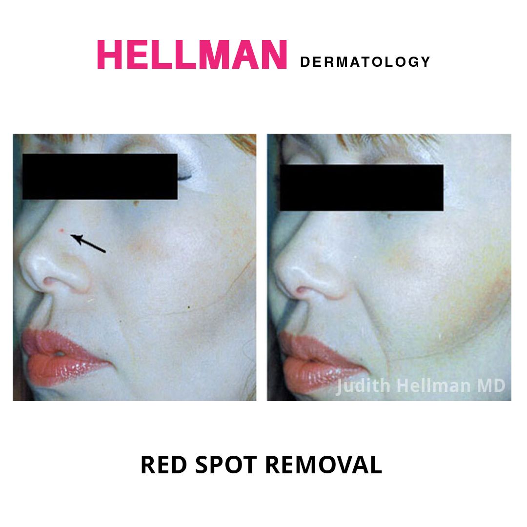 Dr. Judith Hellman uses non-surgical and non-invasive laser treatments to effectively remove red spots from the skin. #beforeandafter #evoke #inmode #redspotremoval #pulsedyelaser #lasertreatments #lumecca #morpheus8