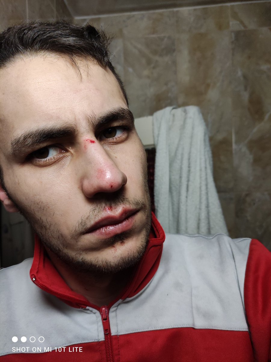 caiser714's tweet photo. Resumen del partido labio roto y las marcas son los tacos de la bota del delantero, la magia de ser portero de futbol, estoy bien aun que no lo parezca acabe el partido y ya estoy dentro n casita 💪💪 https://t.co/ysZG9PhcQ9