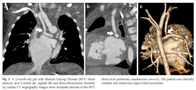 TCHRadiology's tweet photo. CTA post stage 1 Norwood ID'ed more complications compared to the traditional TEE. Find out more about the types of complications and their implications on management here https://t.co/ZfEwfoi43P
@RidaSalman13 @SPJadhavMD @PrakashMasand1 @PamelaKetwaroo @marcos37 @PedRadJournal https://t.co/VDhalCj4Vx