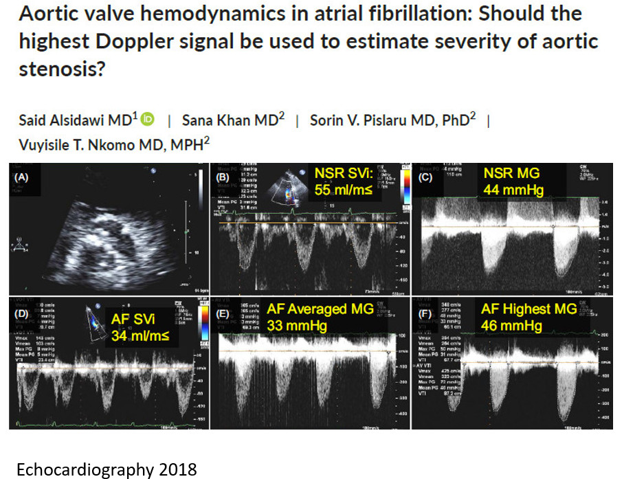 Another variation of this theme is assessing AS in A Fib with different cycle lengths. #Nkomo <a href="/MayoClinicCV/">Mayo Clinic CV</a> have the data that a single highest LVOT and AV velocities can reflect the severity of AS , better than averaging 3 or 5 cycles which is time consuming. See figure below.