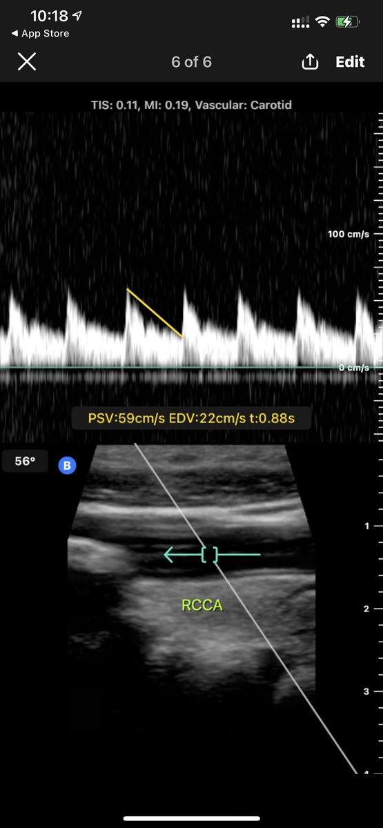 SUHAIBa2t's tweet photo. @ButterflyNetInc  carotid Doppler ultrasound by iphone. It’s amazing..! https://t.co/9YINqm7oDZ