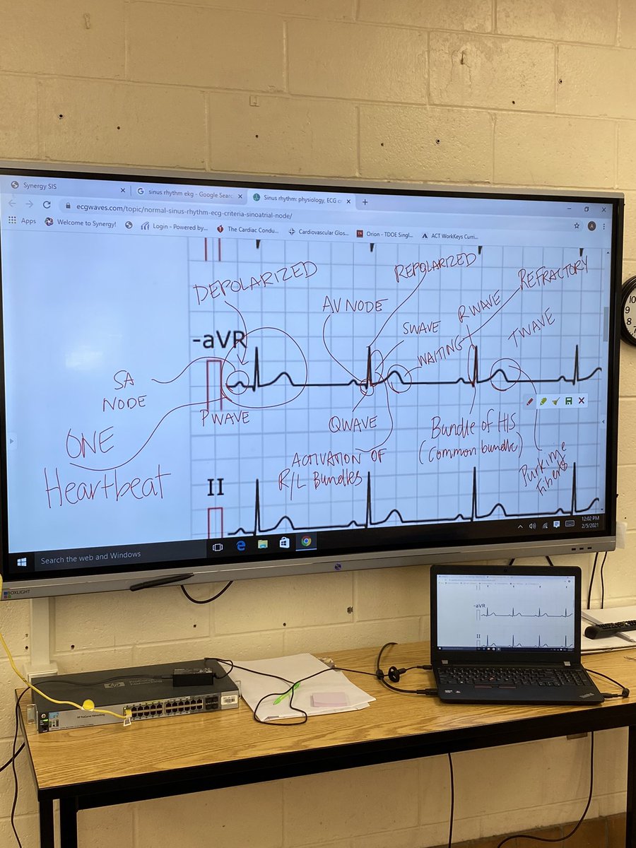 amygwatson18's tweet image. EKGs are hard!  But my students are learning how to find the normal and differentiate the abnormal based on #7questions.  Couldn’t be prouder!
#FuturesBright #ChaseThePWave #MarchItOut