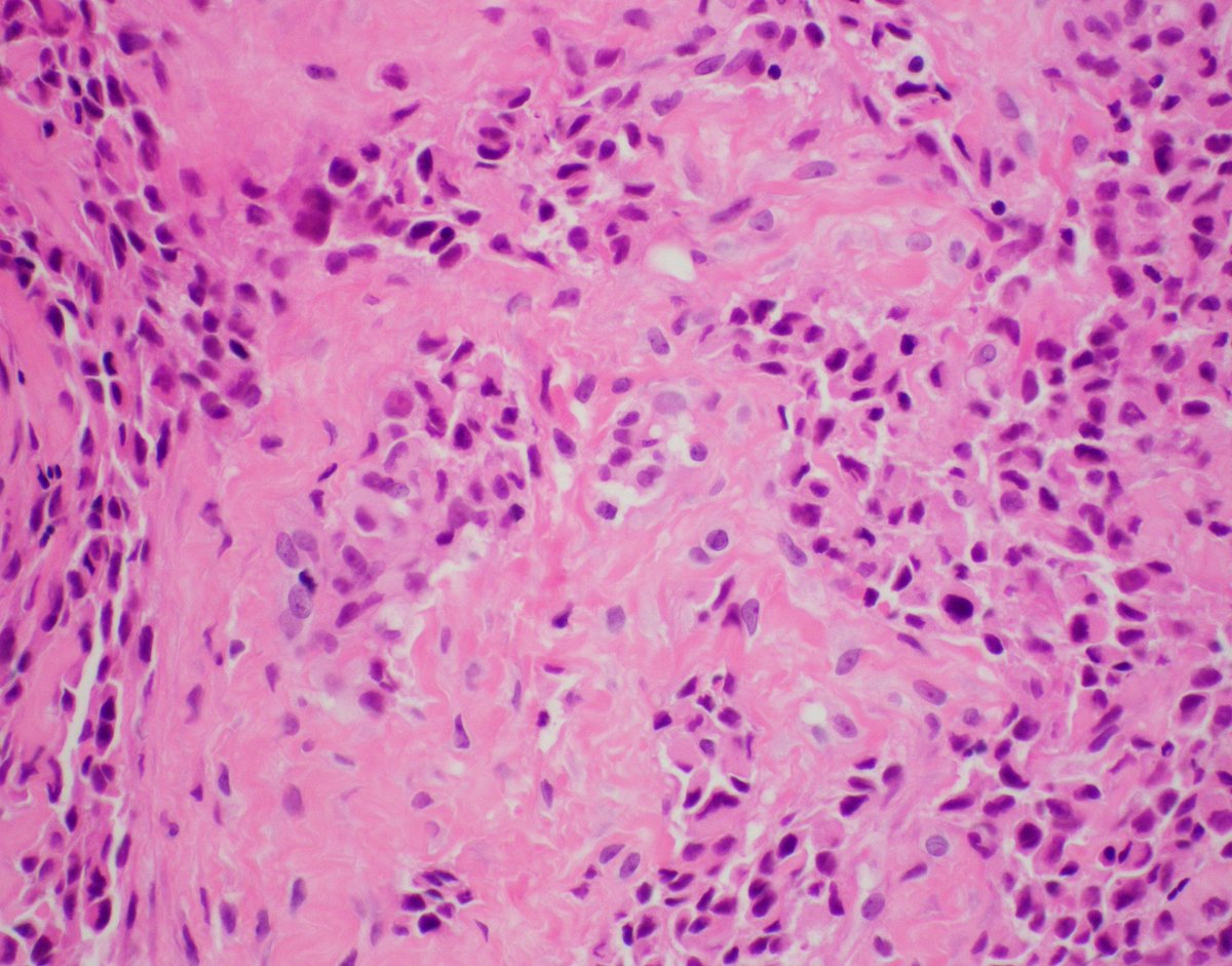 BUMCpath's tweet photo. Telangiectatic osteosarcoma: 3% of osteosarcomas, high grade sarcoma, most in 2nd decade of life. Has blood filled cysts, little osteoid production, expansile lytic metaphyseal bone lesion, similar to aneurysmal bone cyst radiologically. #pathology #BSTpath @sarah_glogowski https://t.co/VpRL41inwc