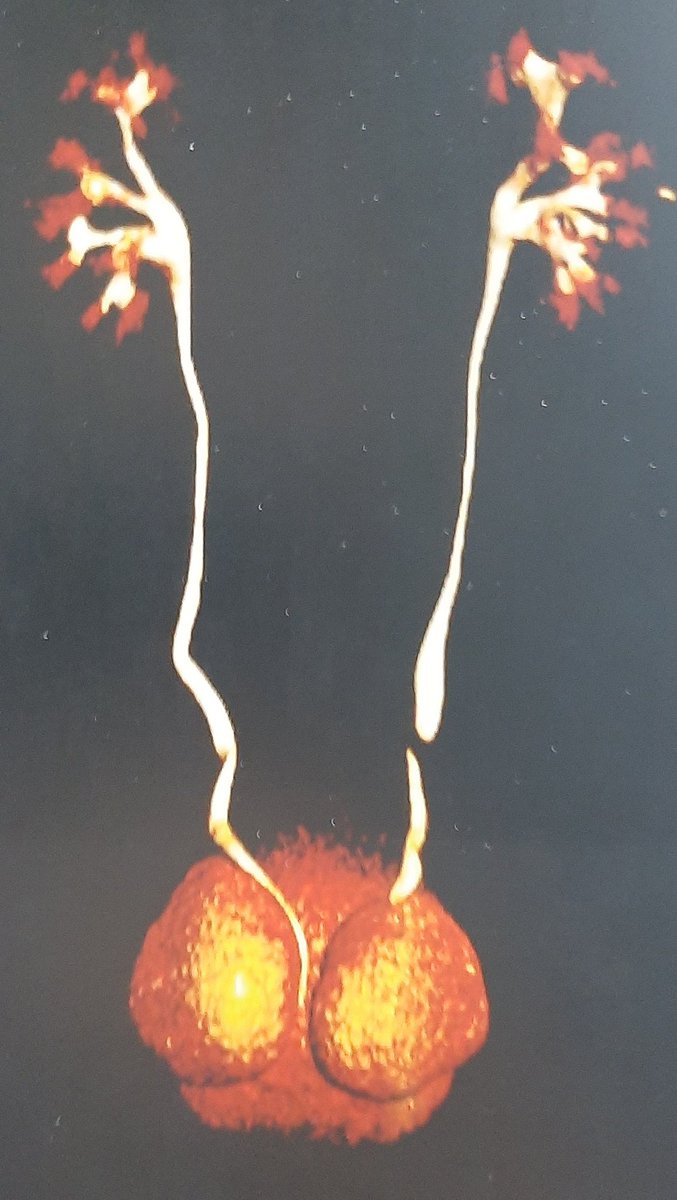Incidentally discovered Hutch diverticulum,  nice Mickley mouse appearance, no reflux