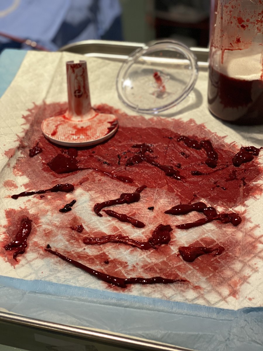 Great case with <a href="/StephenGiangran/">Stephen Giangrande</a> and <a href="/MAlbert94/">Michel Albert</a> using <a href="/PenVascular/">Penumbra Vascular</a>'s CatD to de-clot an acutely thrombosed AV graft.  #SouthernNewHampshire