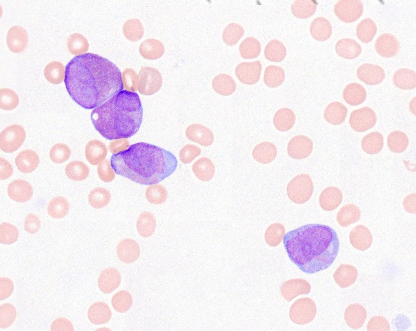 Not Halloween, but always worth sharing scary aspirate with #pathology residents and #hemepath fellows.

Also wanted to show the versatility of <a href="/Basler_AG/">Basler AG</a> camera + <a href="/microvisioneer/">Microvisioneer</a>  scanning system to digitize Wright-Giemsa smears, cytospins, oil...

WSI: utexas.pathpresenter.net/#/public/prese…