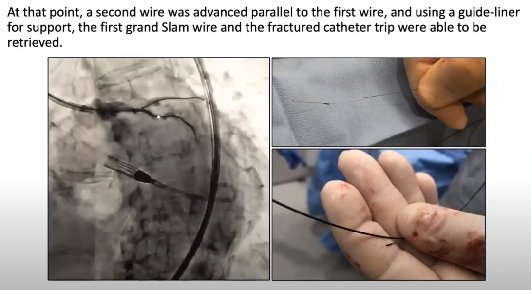 Mauricio G. Cohen MD (@drmauriciocohen) on Twitter photo Check out this moderated case <a href="/SCAI/">SCAI</a> Ischemic Heart Disease council website by superstar fellow <a href="/DevikaKir/">Devika Kir, MD</a> <a href="/UMJMHCardiology/">UMCardiology Fellows</a> describing a cool solution to manage a microcatheter fracture during complex PCI. <a href="/GHernandezMD/">Gabriel A Hernandez MD FACC FSCAI</a> <a href="/evhaddad/">Elias Haddad</a> <a href="/perc_surgeon/">Robert Riley</a> <a href="/evhaddad/">Elias Haddad</a>
youtu.be/r9GBDHjGwTo Check out this moderated case <a href="/SCAI/">SCAI</a> Ischemic Heart Disease council website by superstar fellow <a href="/DevikaKir/">Devika Kir, MD</a> <a href="/UMJMHCardiology/">UMCardiology Fellows</a> describing a cool solution to manage a microcatheter fracture during complex PCI. <a href="/GHernandezMD/">Gabriel A Hernandez MD FACC FSCAI</a> <a href="/evhaddad/">Elias Haddad</a> <a href="/perc_surgeon/">Robert Riley</a> <a href="/evhaddad/">Elias Haddad</a>
youtu.be/r9GBDHjGwTo