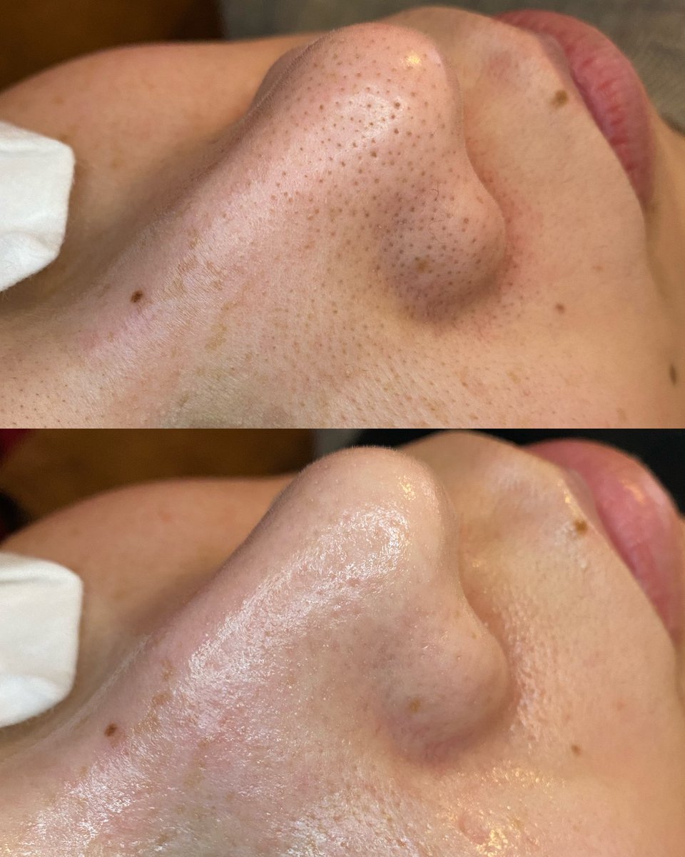 ナージュクリニカルサロン در توییتر 毛穴クリーンケア たった1度で 頑固な毛穴汚れを除去致します ナージュ ナージュクリニカルサロン 名古屋エステ エステ 痩身 痩身エステ 美容 毛穴 毛穴ケア 毛穴クリーンケア 毛穴洗浄 毛穴の黒ずみ 毛穴の