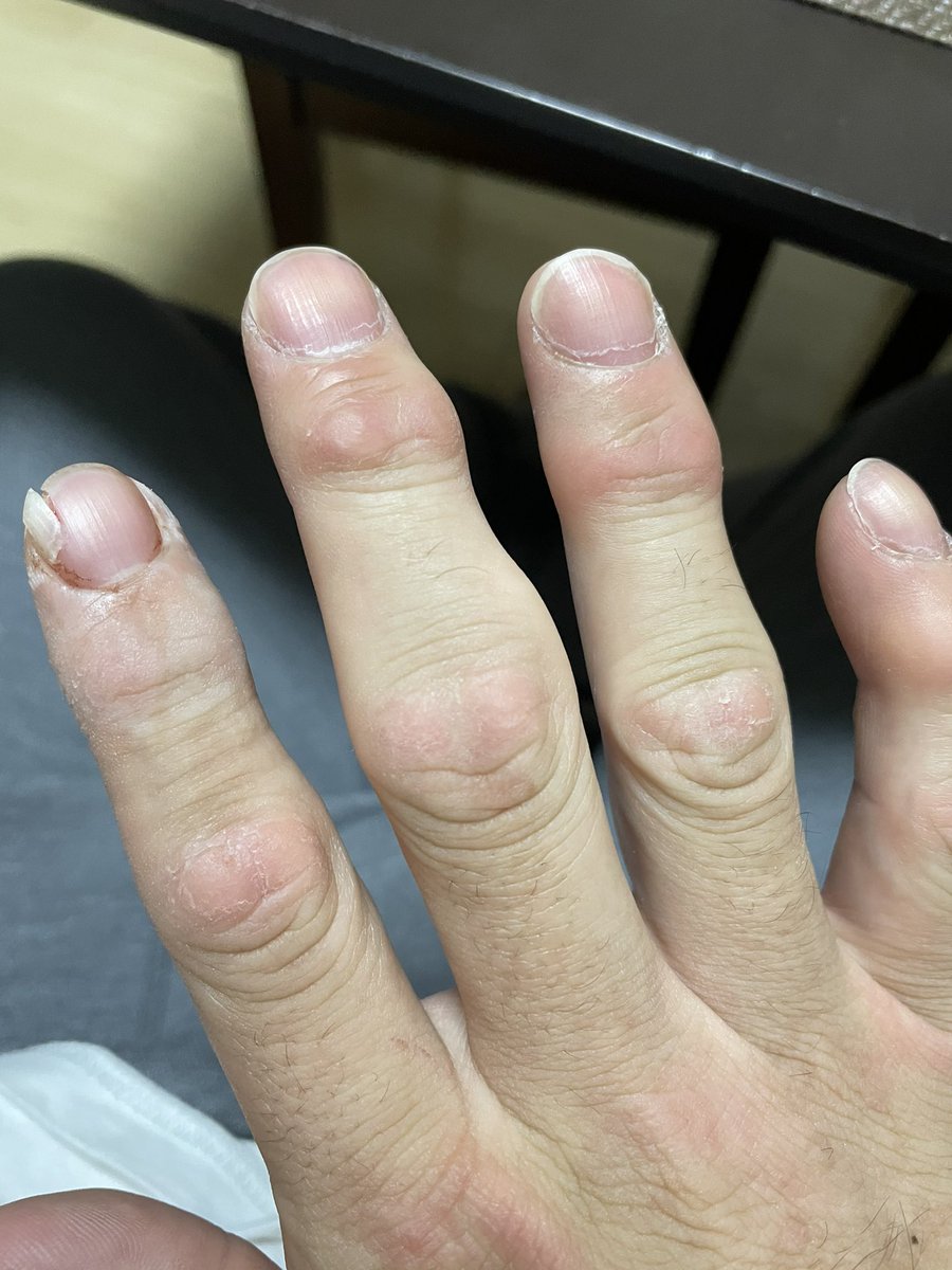 香川 大吾 柔道家は柔道着を握るため 指にタコがたくさんできます 自分の手はまだ綺麗な方です あと 爪が縦に割れます