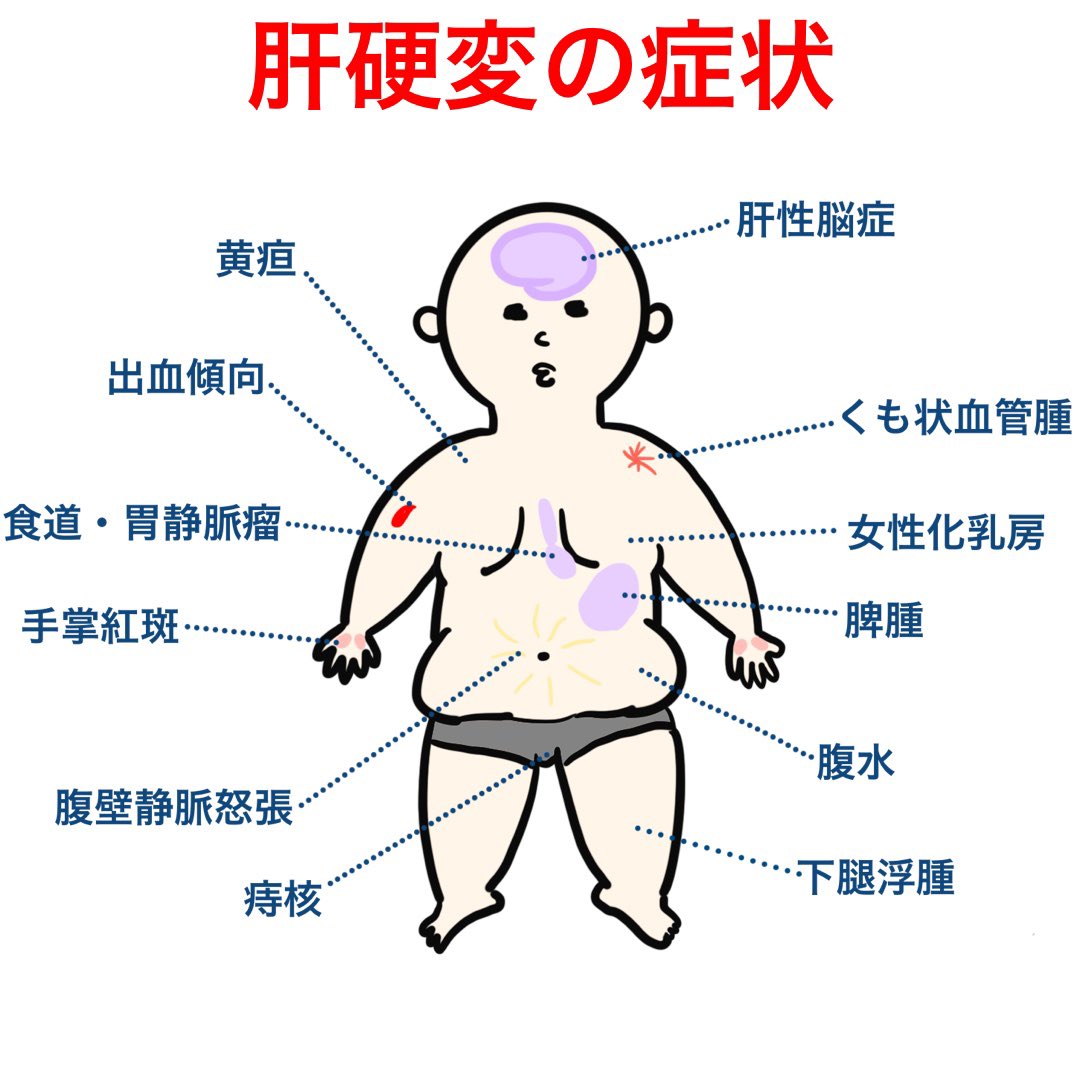 ゴロ 解剖生理イラスト パッと見で分かる 肝硬変の症状 沢山あって覚えるのが大変ですが なぜこれらの症状が現れるのか を生理学の視点で学べば一気に覚えられます Youtubeで解説してます T Co Eiftlhicw9 Twitter