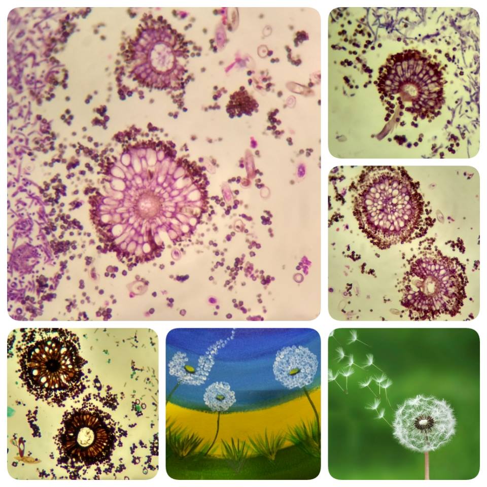 #pathart21 <a href="/loyolapathology/">Loyola Pathology & Laboratory Medicine</a> make a wish :) 
Aspergillus