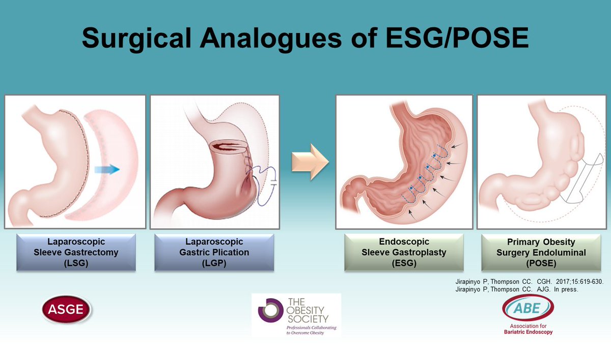 SighPichamol's tweet photo. .@SighPichamol from @BrighamGI : endoscopic sleeve gastroplasty (ESG) appears to work differently mechanistically compared to sleeve gastrectomy (SG) likely due to preserved fundus. @ObesitySociety @ABEbariatric @ASGEendoscopy #obesity https://t.co/WIc6Wxv6Jv